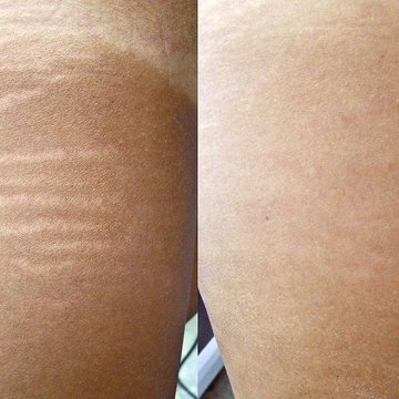 Stretch-mark-2nd-Exmple-At-Inked-In-Asia-Tattoo-Studio-Patong-Phuket-Thailand.jpg